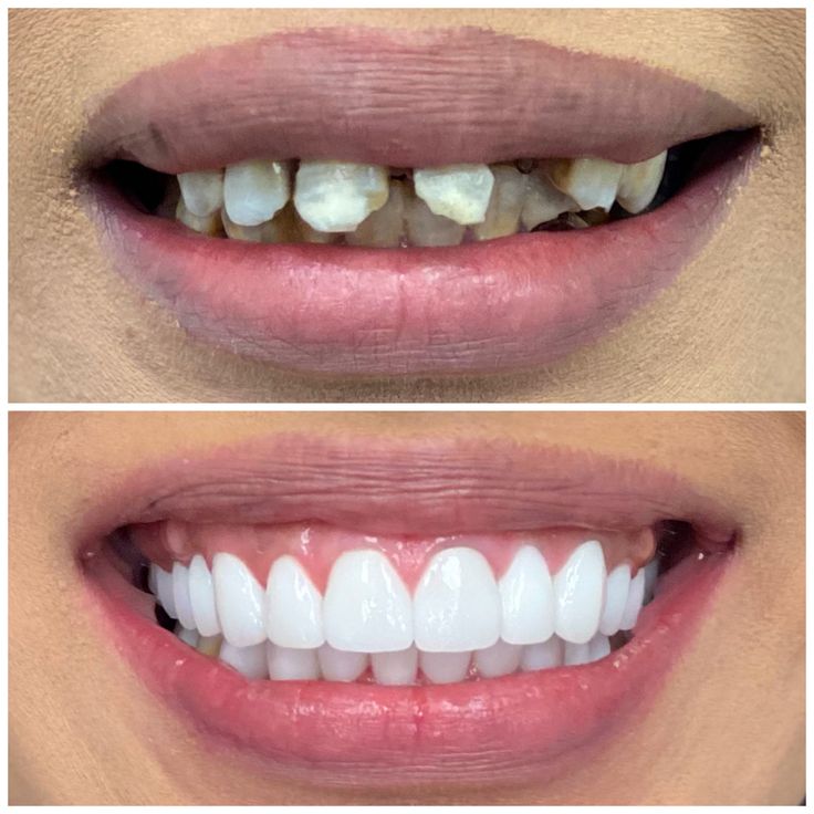 Before smile makeover